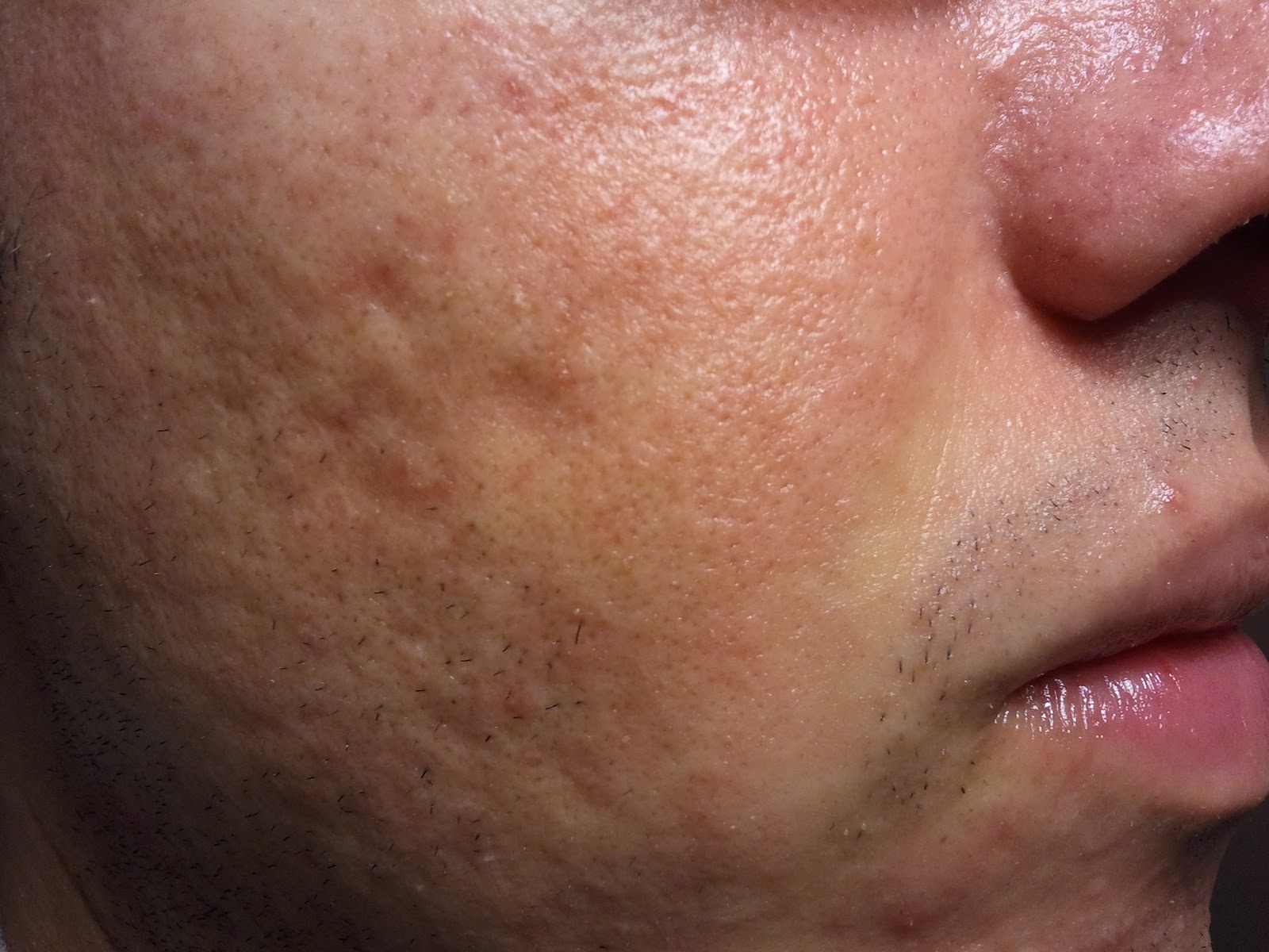 acne after accutane